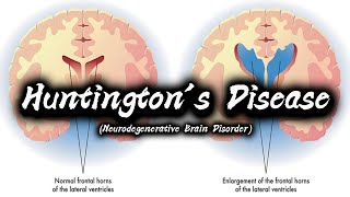 Huntingtons Disease  Types  Symptoms  Causes  Diagnosis  Treatment Options  Preventions [upl. by Burdett725]