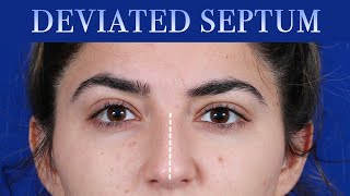 How To Fix A Deviated Septum  Dr Moustafa Mourad  Mourad NYC [upl. by Tterej]