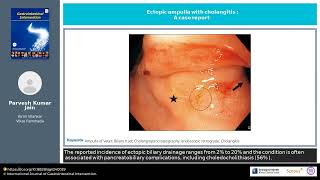 Ectopic ampulla with cholangitis A case report [upl. by Shirberg]