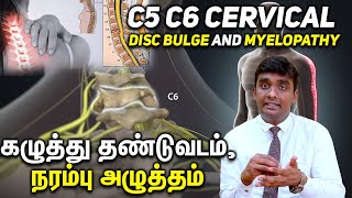 C5 C6 Cervical Disc Bulge and Myelopathy கழுத்து தண்டுவடம் நரம்பு அழுத்தம் Part 1 [upl. by Enihpled]