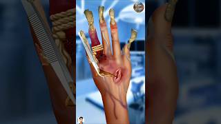 ASMR Hand Surgery  3D Animation Surgery asmr 3danimationsurgery 3danimation surgery treatment [upl. by Walke772]