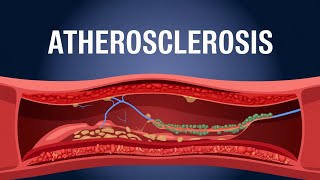 Atherosclerosis animation understanding Atherosclerosis [upl. by Penny]