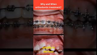 quotWhy and When Do You Need Orthodontic Treatment  DentalHealth365quotshorts [upl. by Dnomyar]