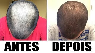 Evolução do tratamento  Antes e Depois  Minoxidil Kirkland  Cabelo  4 Meses [upl. by Aggarwal762]