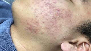 ACNE TREATMENT VU QUYNH MI Acne On Teens Cheek 2024 [upl. by Struve]