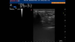 MUSCULOSKELETAL ULTRASOUND TARSAL TUNNEL Flexor Digitorum Longus [upl. by Ysnil]