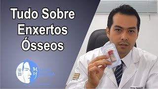 Tudo sobre exertos ósseos Conheça os tipos de enxertos e suas aplicações [upl. by Eerehc]