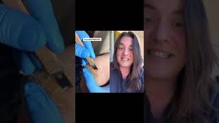 DUET REACTION medical callus removal PPK Keratoderma Callus Hyperkeratosis  Jun 1 2023 [upl. by Roots]