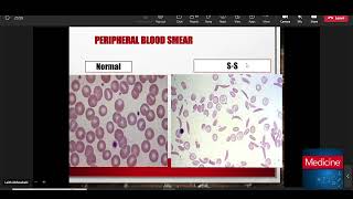 Hemoglobinopathies [upl. by Lidaa]