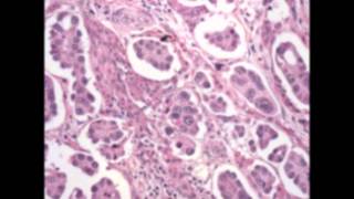 Bladder pathology  topic 6 Urothelial Carcinoma and Its Variant [upl. by Tomlinson204]