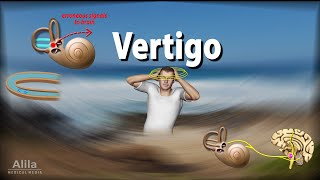 Vertigo Causes Pathophysiology and Treatments Animation [upl. by Salomone]