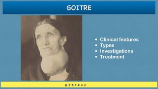 Goitre  Clinical features  EthologyCauses  Types  Investigations  Treatment [upl. by Hacker795]