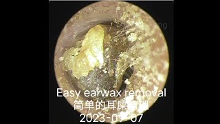 Easy earwax removal简单的耳屎清理20230907 [upl. by Sirkin]