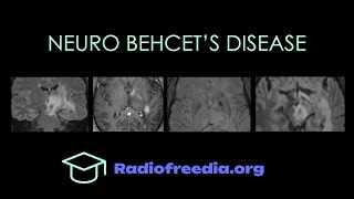 Neuro Behcets Disease Imaging Walkthrough  Radiofreediaorg [upl. by Julee110]