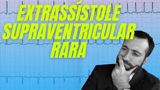 Extrassístole supraventricular rara [upl. by Cox]