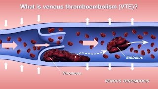 Understanding and Diagnosing Venous Thromboembolism VTE [upl. by Creedon]