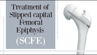 treatment of slipped capital femoral epiphysis SCFE  hip pain in children [upl. by Inah24]