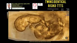 Twins dgn risiko TTTS syndrome [upl. by Agripina574]