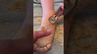 Removing callus from kid feet  Keratoderma hyperkeratosis EPPK skin shaving callous  May 29 2023 [upl. by Amalita406]