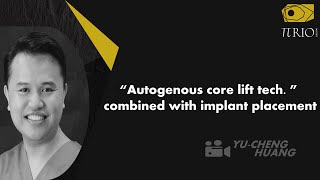 “Autogenous core lift tech ” combined with implant placement [upl. by Ephrayim95]