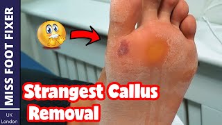 STRANGEST Callus Removal From Foot Full Treatment By Miss Foot Fixer [upl. by Anaiad]