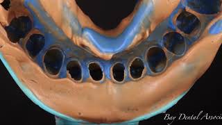 Feldspathic Veneers [upl. by Ethbin912]