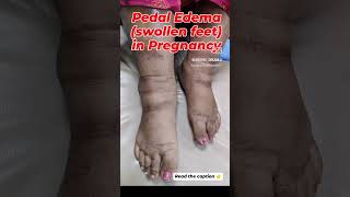 Pedal Edema during pregnancy Sudden and excessive swelling might be a indicator of Preeclampsia👉 [upl. by Nilyahs]