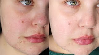 AFFORDABLE LASER TREATMENT FOR ACNE SCARS  IPL Laser Before amp After [upl. by Lebasiram]