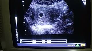 How to find gestational sac with TAS ultrasound at 4 weeks by Dr Fatima [upl. by Avir]