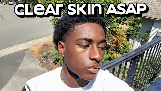 how to get clear skin for guys asap [upl. by Glavin]