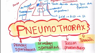 Pneumothorax Types and Treatment Respiratory 46  First Aid USMLE Step 1 in UrduHindi [upl. by Idas]