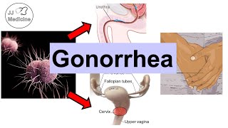 Gonorrhea Neisseria Gonorrhea  Pathophysiology Symptoms amp Complications Diagnosis Treatment [upl. by Dwan]