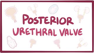 Posterior urethral valve PUV  causes symptoms diagnosis treatment pathology [upl. by Tandie]