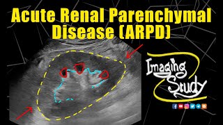 Acute Renal Parenchymal Disease  Ultrasound  Case 333 [upl. by Cilurzo]