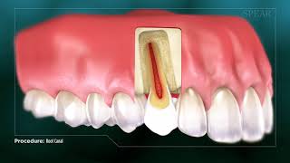 What Is Root Canal Treatment [upl. by Duntson779]