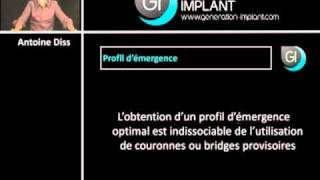 Implant dentaire  Profil démergence et prothèse transitoire [upl. by Pilar348]