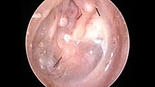 Otoendoscopy  Retracted Ear Drum [upl. by Eltotsira]