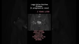 LEGGCALVEPERTHES DISEASE XRAYCT A PROGRESSIVE CASEA new case every daySame time tomorrow [upl. by Aihsercal]