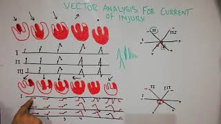 CVS physiology 39 Vectorial analysis for current of injury [upl. by Herve228]