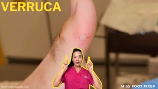 Quick amp Effective Verruca Removal Advanced Treatments Explained  Miss Foot Fixer [upl. by Jonell836]