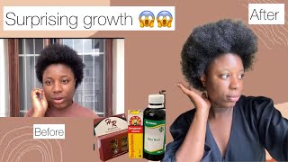 Surprising Results😱 My Hair Growth Journey with bayrum bergamot placenta  Debiee O [upl. by Yanffit]