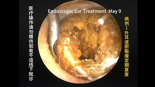 Cholesteatoma Regular review and cleaning [upl. by Aruol]