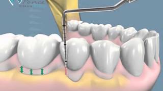 Sondaje Periodontal [upl. by Yelahc]