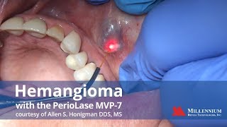 Hemangioma treatment with the PerioLase MVP7 [upl. by Ver297]