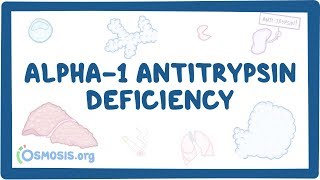 Alpha1 Antitrypsin Deficiency  causes symptoms diagnosis treatment pathology [upl. by Yemorej]