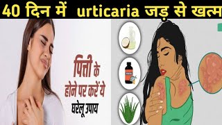 40 दिनों में urticaria जड़ से खत्म  urticaria treatment in hindi  urticaria in hindi urticaria [upl. by Avla14]