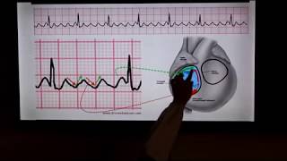 Mechanism of Arrhythmias and Antiarrhythmic Medications [upl. by Anyek]