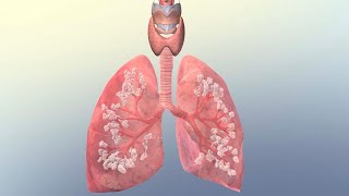 Common Causes of Respiratory Failure [upl. by Kristofer]