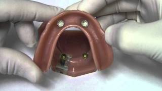 Implant Overdenture  Model Demonstration [upl. by Onaivatco169]