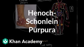 HenochSchonlein purpura  Circulatory System and Disease  NCLEXRN  Khan Academy [upl. by Entwistle]